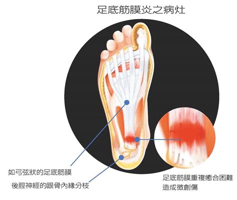 吱腳板底|足底筋膜炎 症狀有哪些？位置、原因、治療舒緩方式。